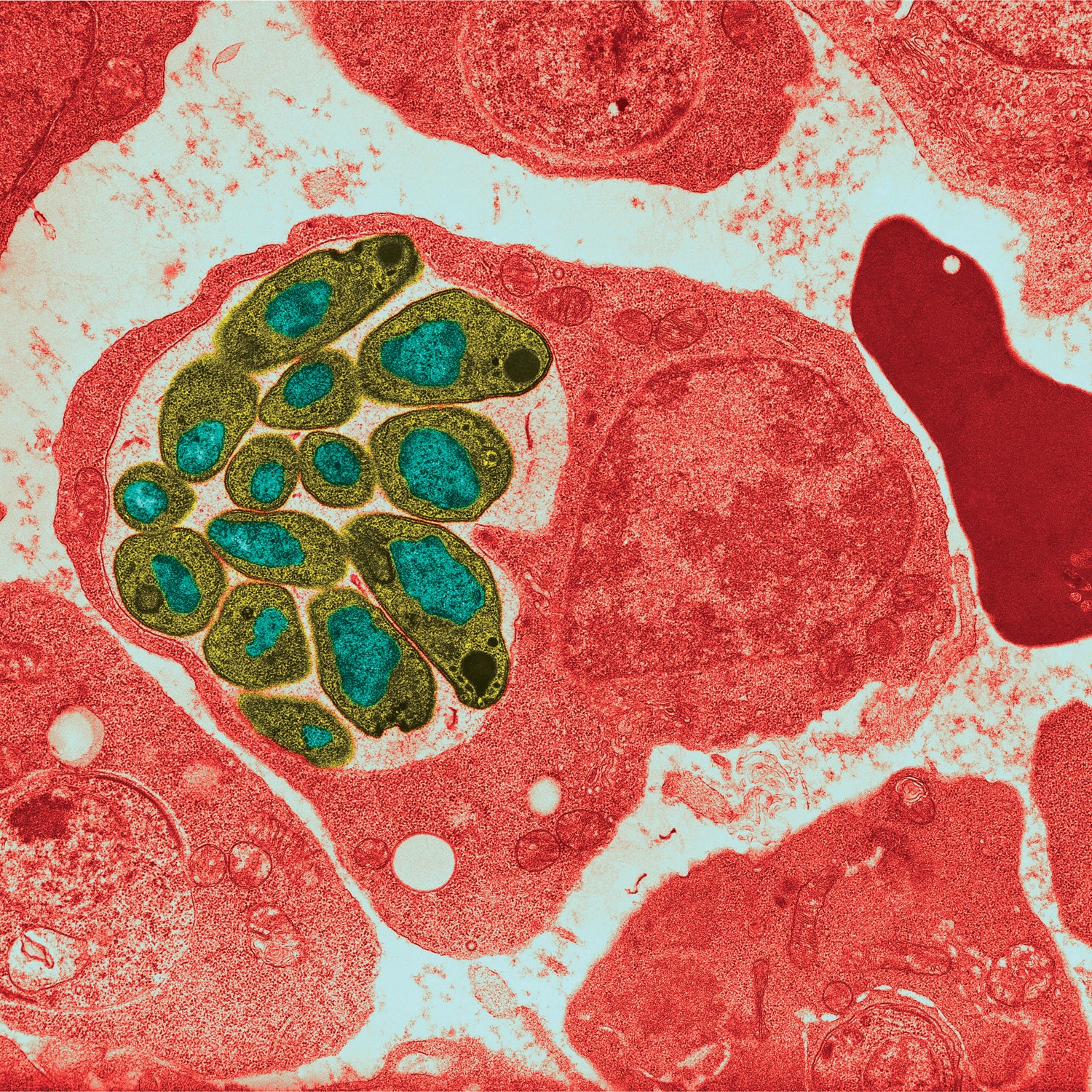 Malaria parasites attacking blood cells.