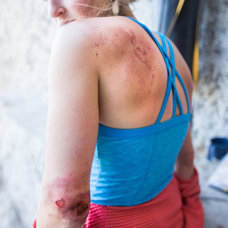 Battle wounds as a result of going to war with the Monster. I’d struggled so hard to stay inside the crack that I wore a hole in my elbow and scraped all the skin off my left shoulder.