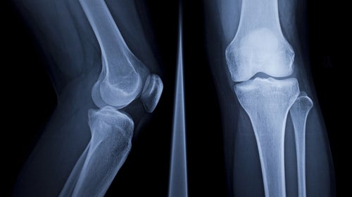 Simple strength exercises and regular aerobic training can improve bone health preemptively.