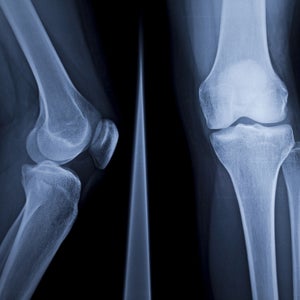 Simple strength exercises and regular aerobic training can improve bone health preemptively.