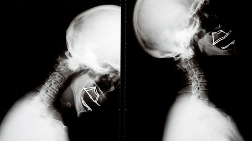 Concussions sit in a gray area where the athlete decides when to return to play, a decision that can cost far too much.