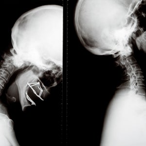 Concussions sit in a gray area where the athlete decides when to return to play, a decision that can cost far too much.