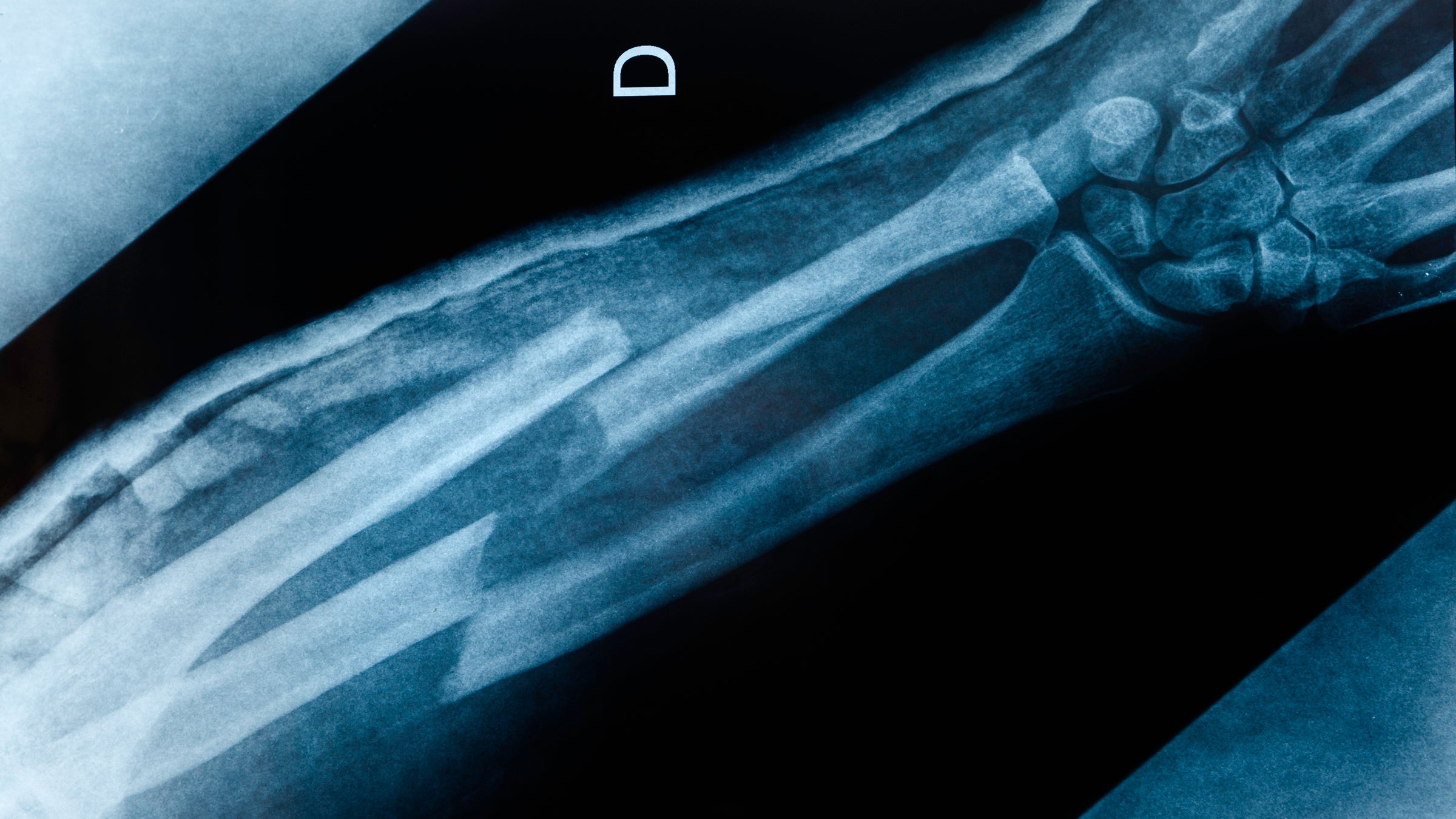 An x-ray image of an boken arm with double fracture: radius and ulna.