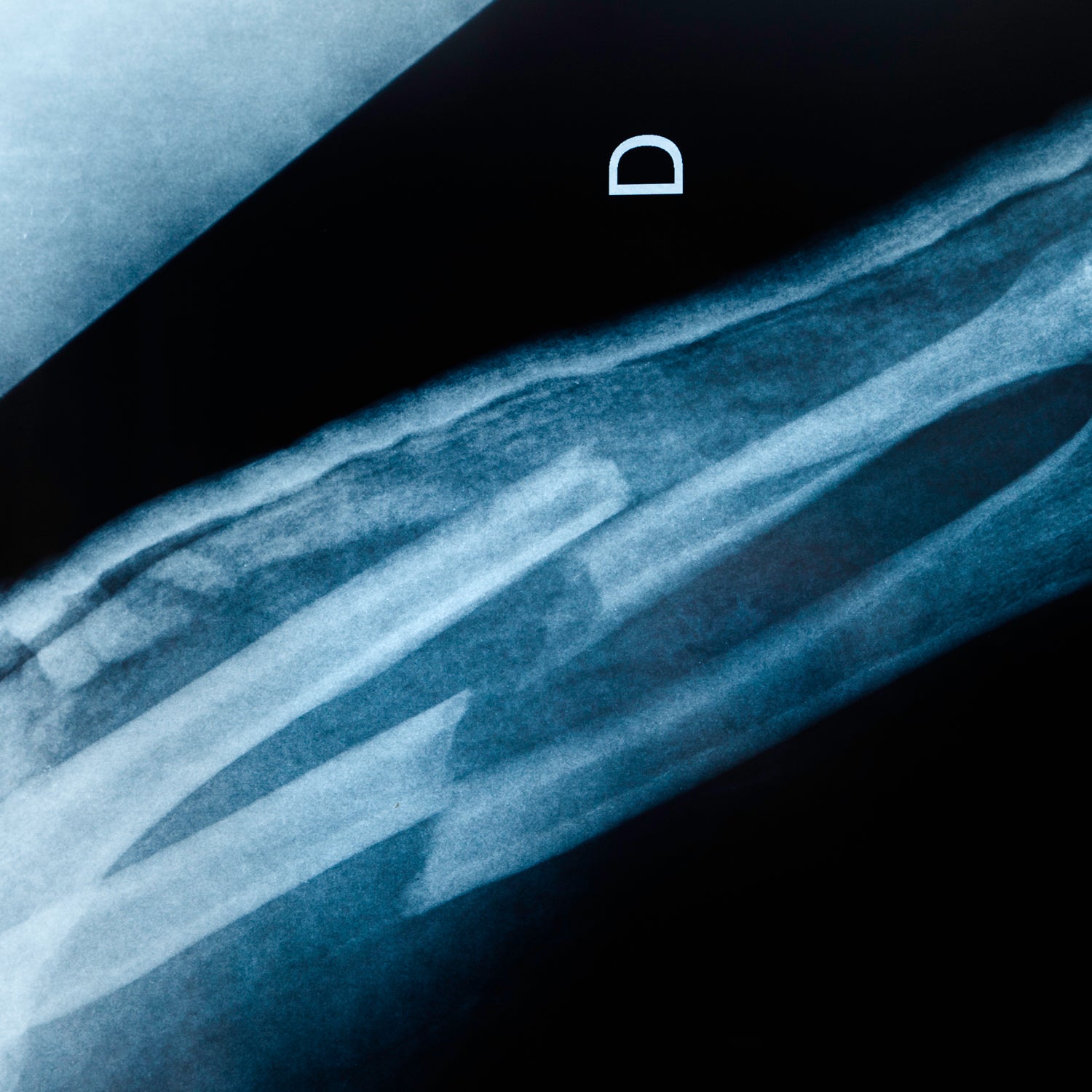 An x-ray image of an boken arm with double fracture: radius and ulna.