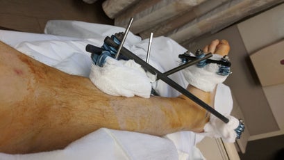 An external fixator binding bones in Florine's left leg together.
