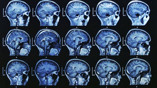 Women's brains may recover faster than men's after a concussion.