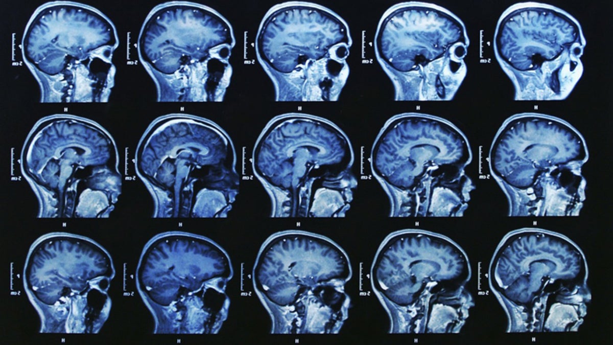 How Sex Affects Concussion Recovery