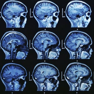 Women's brains may recover faster than men's after a concussion.