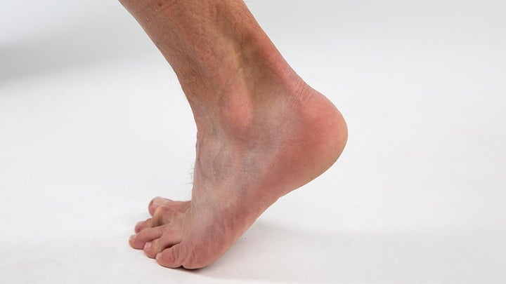The Achilles Tendon: What Goes Wrong for Runners