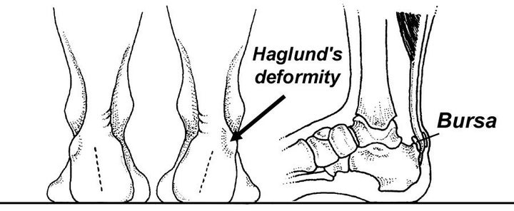 Haglund's deformity and bursa