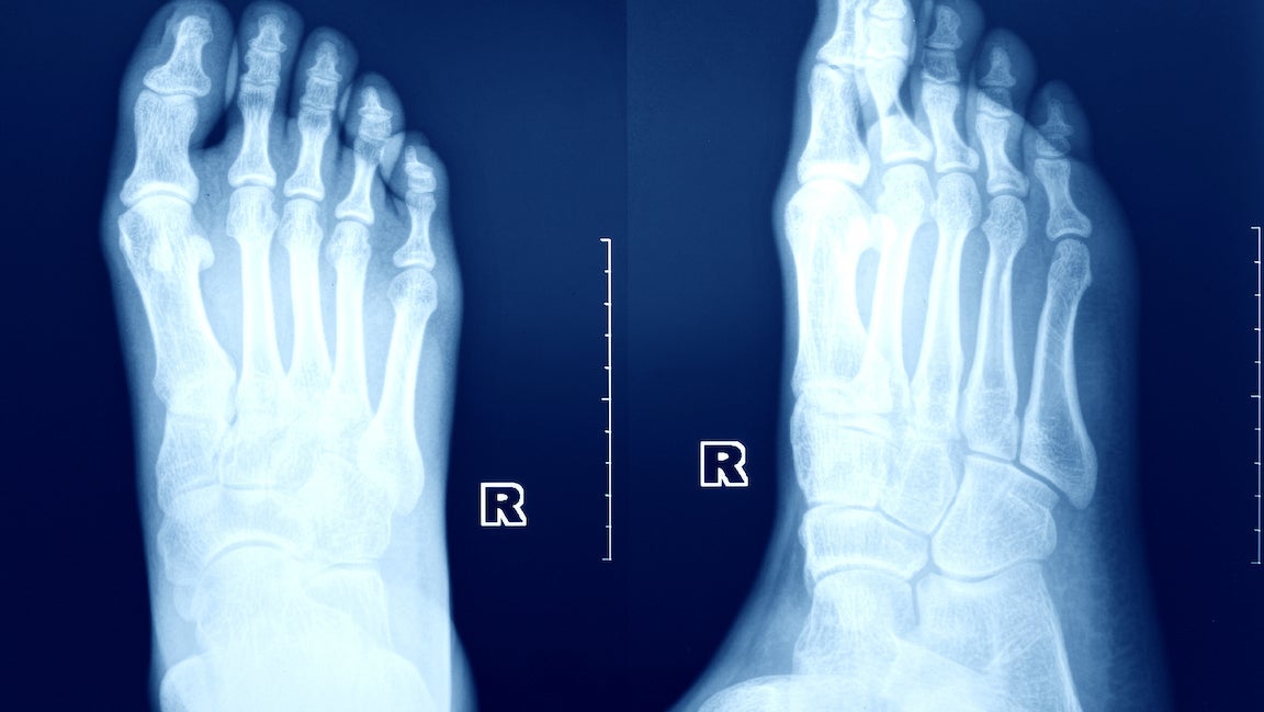 long bone fracture