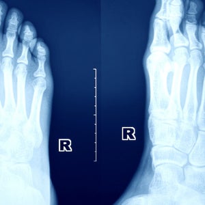 Stress fracture image of the food.