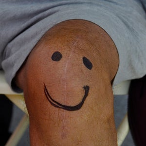 running with a replacement knee