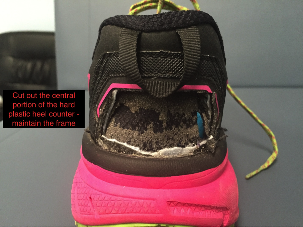 heel counter surgery