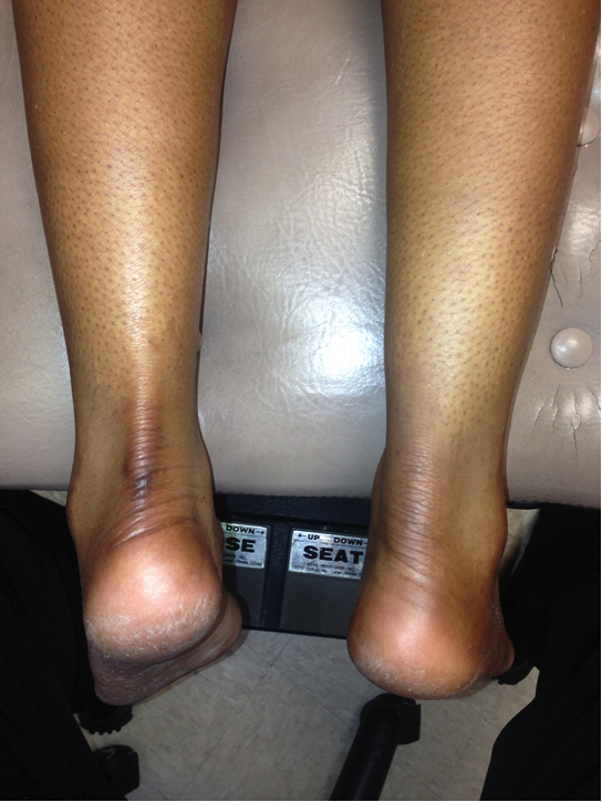 swollen Achilles tendon