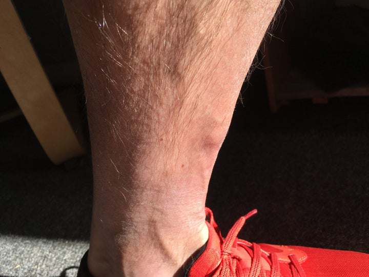 tibial stress fracture bump