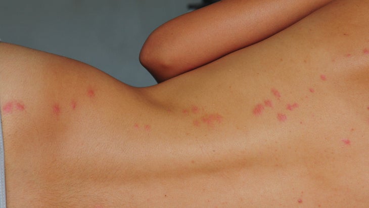 Linear or zigzag bite marks indicate bedbugs