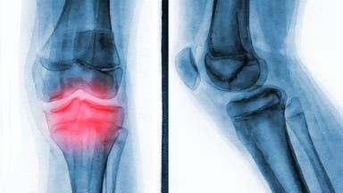 The More You Cycle, the Lower Your Risk of Knee Arthritis