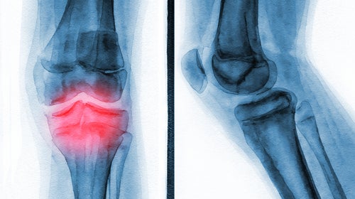 Illustration of a knee x-ray showing pain from arthritis