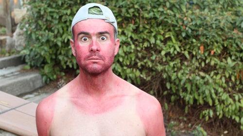 A shirtless man with a horribly red sunburn that reflects he was wearing a tank top.