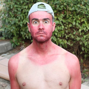 A shirtless man with a horribly red sunburn that reflects he was wearing a tank top.