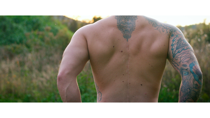 adaptive rider showing their spinal cord surgery scar