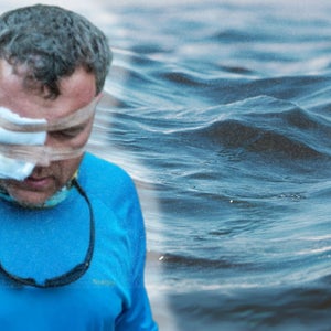 Jim Klug with bandage over his eye