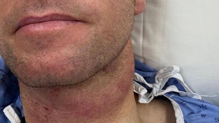 Copenhagen suffered minor damage to the hyoid bone in his neck and cricoid cartilage around his voice box