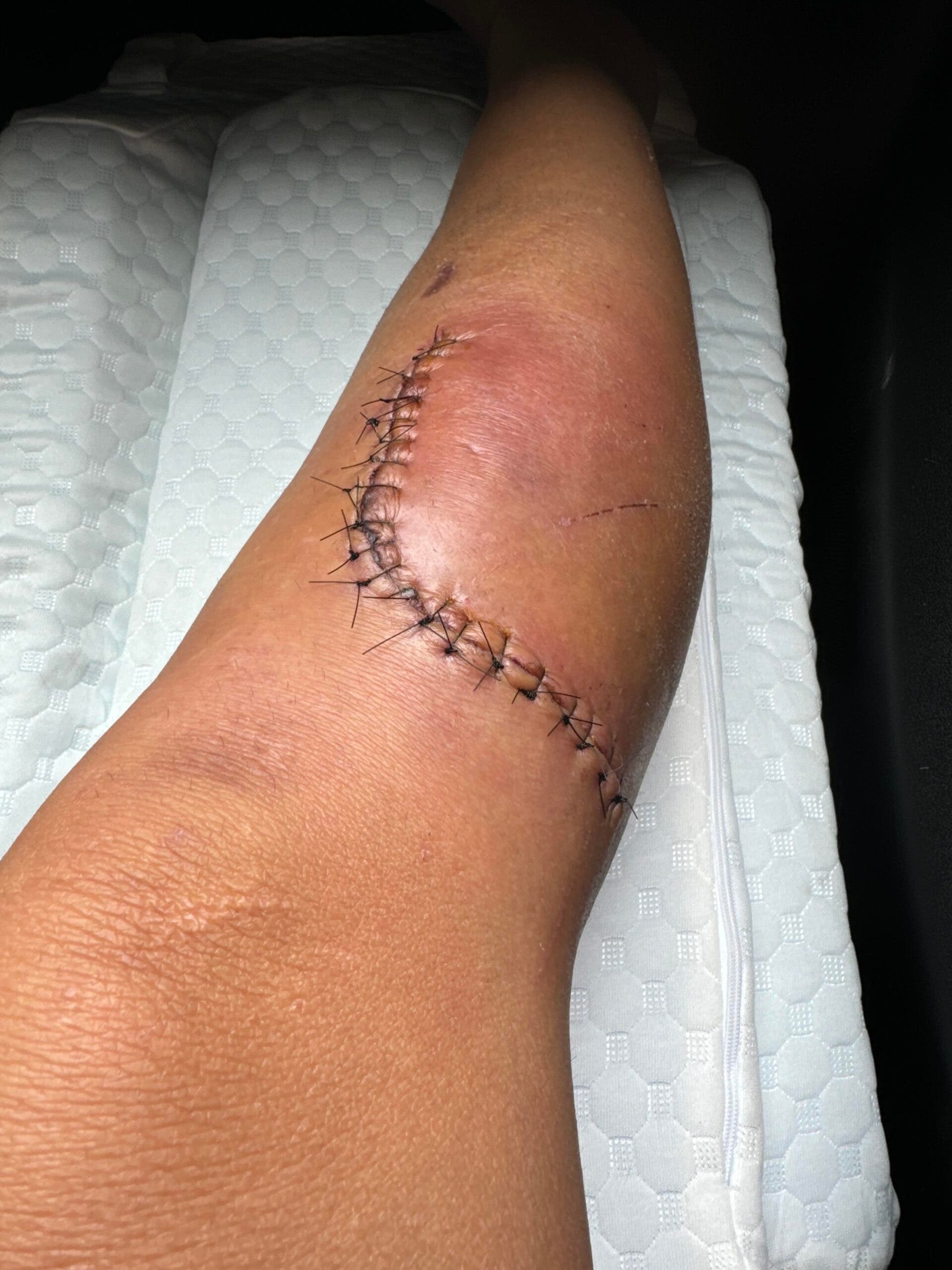 stitches after a bike crash