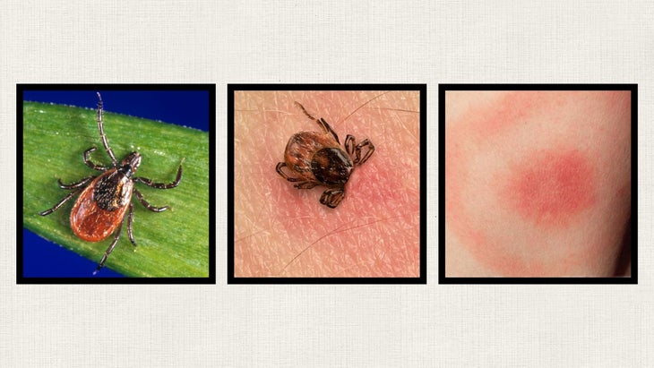 black-legged-deer-tick and lyme disease rash
