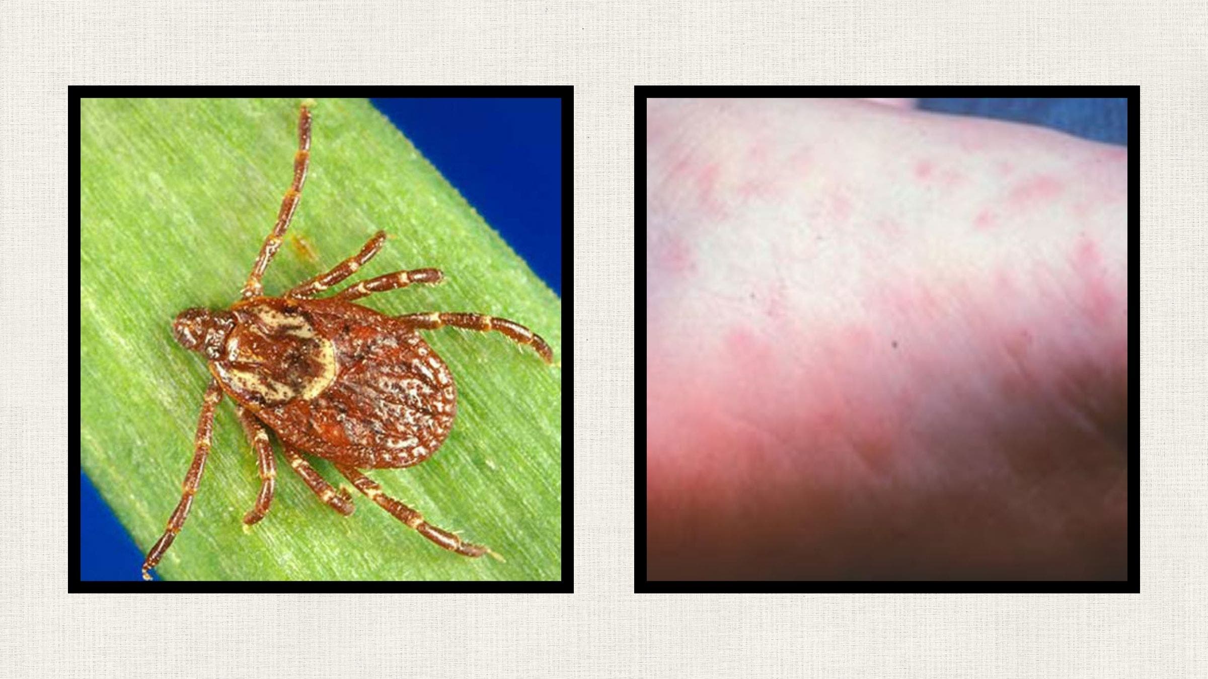 American Dog Tick and RMSF rash