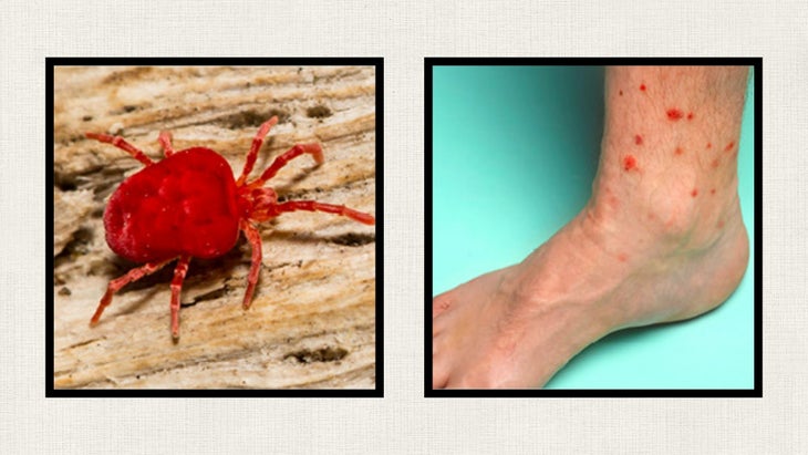 chigger and chigger bite