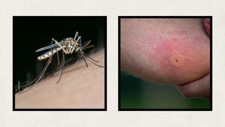 Left: Mosquito feeding on skin; Right: Mosquito bite (Photo: Cleveland Clinic)