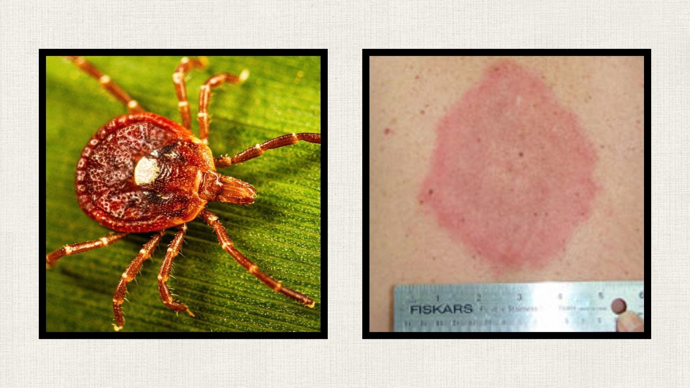 Left: Female Lone Star Tick with its trademark white spot on the back; Right: STARI rash
