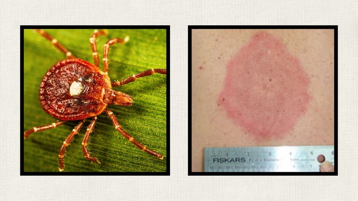 Left: Female Lone Star Tick with its trademark white spot on the back; Right: STARI rash