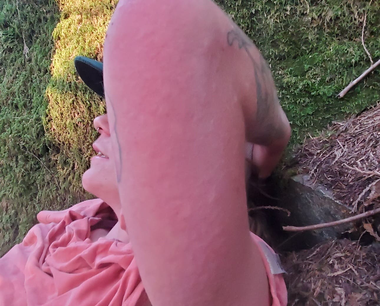 the arm of the climber shows multiple wasp stings, is swollen and red