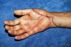 Craig Bovim's mangled hand after the attack