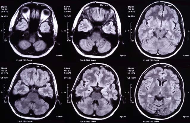 Head injury x-ray