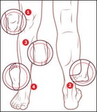 Running Injuries