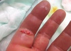 Rusch's painful finger injury.