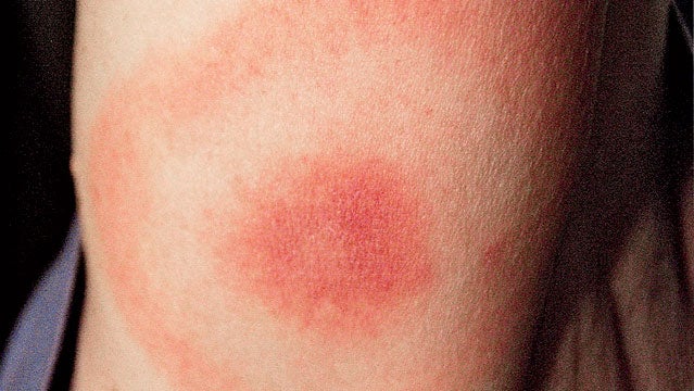 Lyme Disease 10 Times More Common Than Estimated