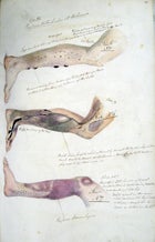 国产吃瓜黑料Online scurvy leg criminals symptoms medical drawing Henry Walsh Mahon