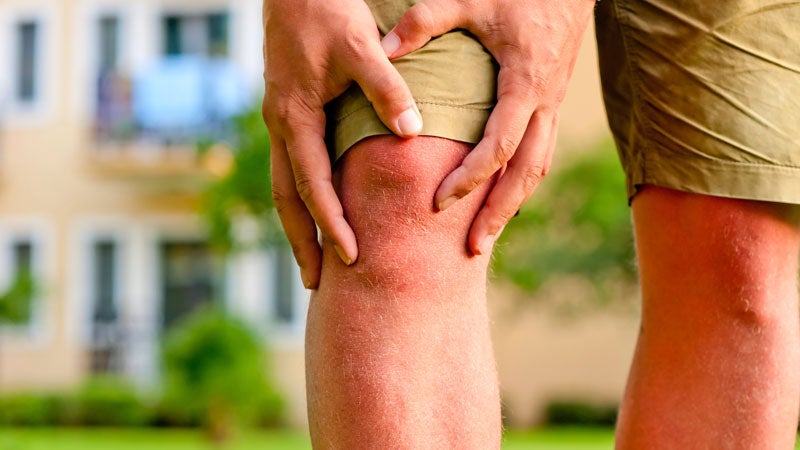 How should you treat an ACL injury?