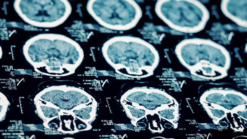 New concussion study shows lasting affects