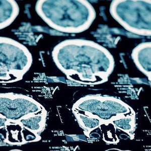 New concussion study shows lasting affects