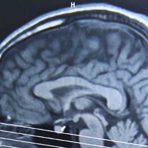 Scientists have shed new light on the effects of concussions.