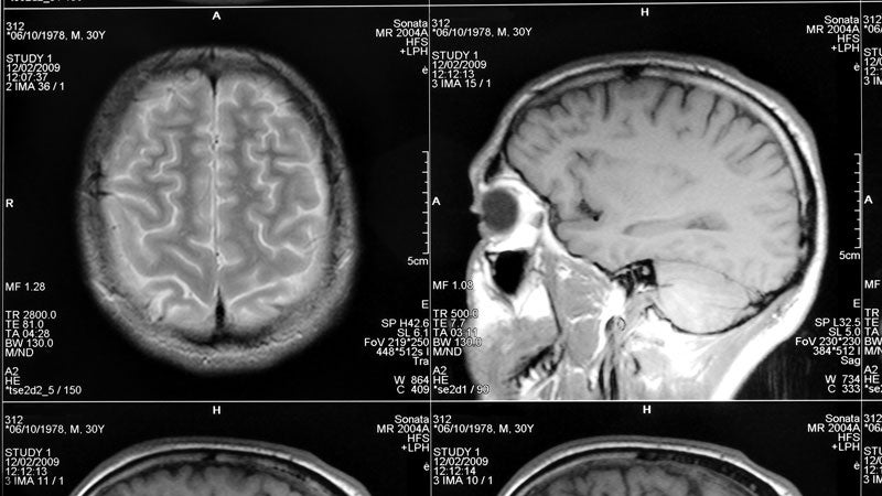 mri medicine healthcare scan x-ray brain illness image human medical head technology anatomy scanner bone skull resonance patient diagnostic examining science film imaging skeleton person tumor conscious life disease artery research tomogram laminagram stratigram sectional inside photograph picture shot photo brainpan cranium headbone brain-convolution gyrus MR-image MR-scan magnetic closeup macro