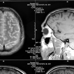 mri medicine healthcare scan x-ray brain illness image human medical head technology anatomy scanner bone skull resonance patient diagnostic examining science film imaging skeleton person tumor conscious life disease artery research tomogram laminagram stratigram sectional inside photograph picture shot photo brainpan cranium headbone brain-convolution gyrus MR-image MR-scan magnetic closeup macro