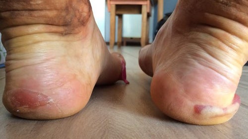 Running 135 miles earns you bragging rights and blisters.