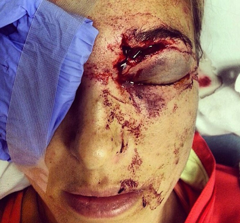 Morgan Miller's Eye Injury Could Impact Her Professional Volleyball Career  (Photos) 